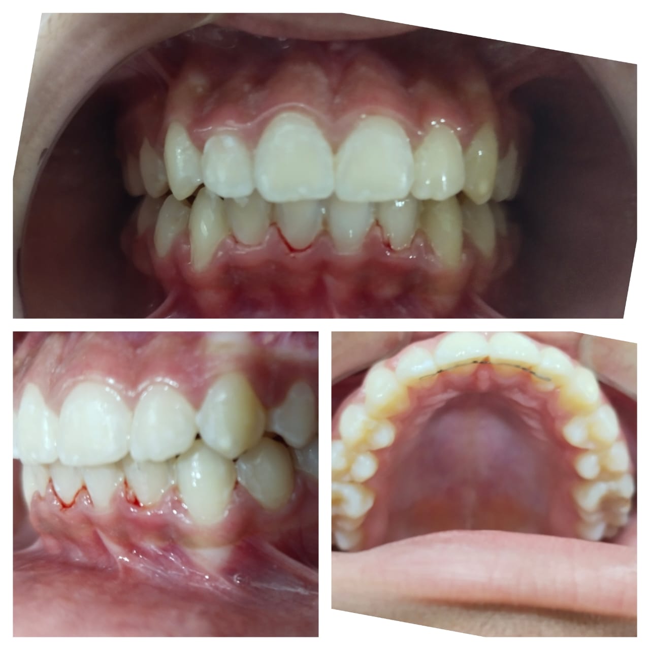 Before and After Smile 1